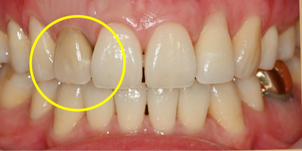 Before Treatment