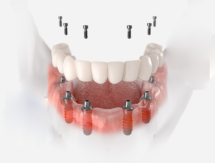 Bridge-type implant