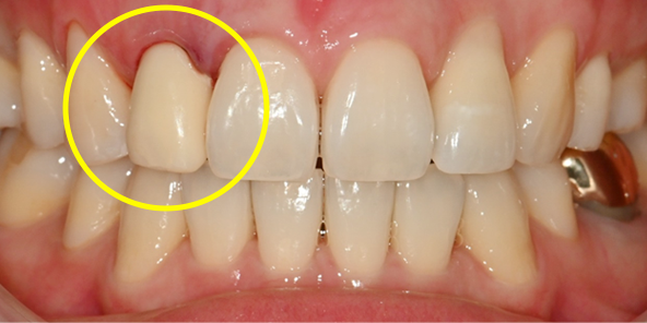수술 당일 보철물 즉시 완성